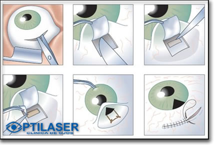Clinica de ojos Optilaser - Cirugia Glaucoma